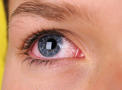 دیابت و ارتباط لکه های درون چشم با آن